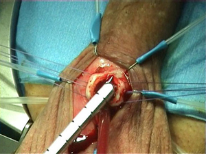 Хірургія при імпотенції фаллопротезірованіе, відновлення артерій, чоловічі імплантати