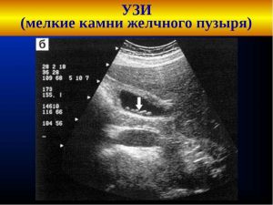 Pietrele de colesterol din simptomele și tratamentul vezicii biliare