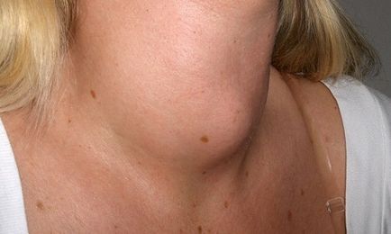 Tiroidita cronică a simptomelor glandei tiroide și tratamentul bolii
