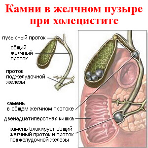 Захворювання жовчного міхура ознаки і симптоми