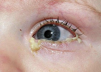 Закисає очей у новонародженого, причини і як лікувати