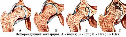 Зарядка при коксартрозе лікування коксартрозу кульшового суглоба народними засобами в домашніх