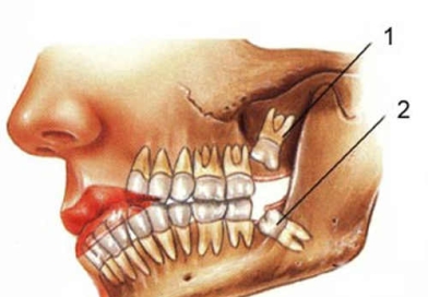Зуби мудрості видаляти чи не видаляти