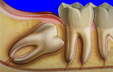 Зуби мудрості видаляти чи не видаляти