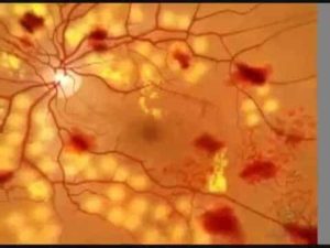retina angiopátia szemek