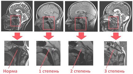 Аваміс при аденоїдах у дітей свідчення і особливості застосування