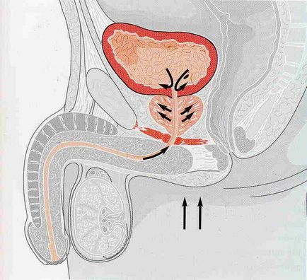 Prostatita inflamatorie asimptomatica (categoria 4)