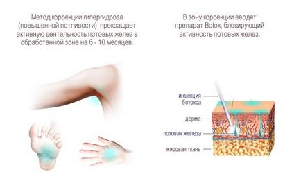 Botox în axilă - tratament eficient al hiperhidrozei de către Botox