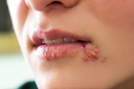 Frecvența herpesului pe buze cauzează și ce trebuie să facă