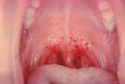 Frecvența herpesului pe buze cauzează și ce trebuie să facă