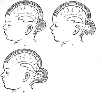 Черепно-мозкова грижа класифікація, симптоми і лікування