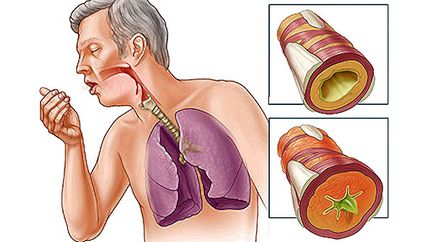 Mi bronchitis, Health magazin - 2. rész