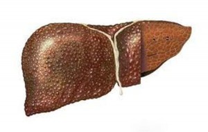 Ciroza hepatică nu este o propoziție