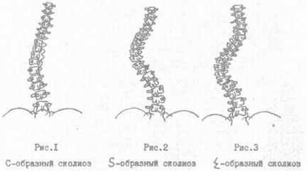 Scolioza în formă de C 1, 2, 3 și 4 grade ale simptomelor pe partea dreaptă și pe partea stângă, tratament