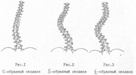 C подібний сколіоз 1, 2, 3 і 4 ступеня правобічний і лівобічний симптоми, лікування