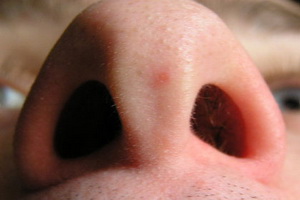 Дифтерія носа симптоми і лікування
