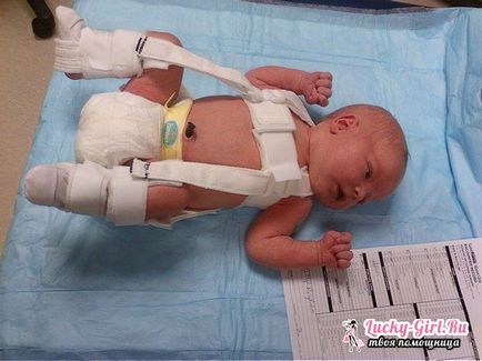 Дисплазія тазостегнових суглобів у дітей симптоми і методи лікування