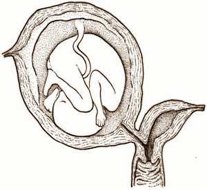 Uterul dublu-coarne al cauzei, un uter bicornic - ceea ce este, o bicornială și o sarcină