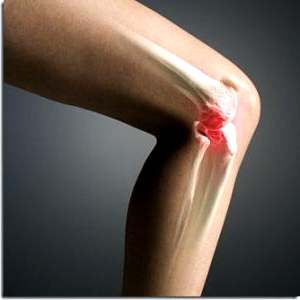 Ефективне лікування гонартрозу колінного суглоба дієві способи, народна медицина