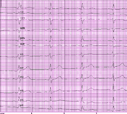 EKG 5