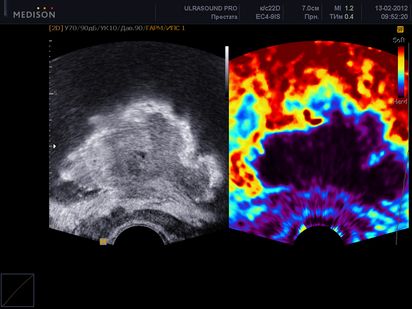 Elastografia din Krasnodar - clinica Catherine