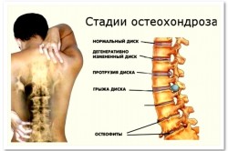 Electroforeza cu novocaină pentru osteochondroză