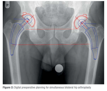 Ендопротезування двох кульшових суглобів одномоментно