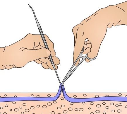 Operație endovasculară pentru vene varicoase (phlebectomy) - operații și proceduri - mts bios, medical