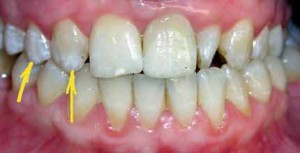 Fluoroza dinților ceea ce este, fotografii și simptome, tratament la copii și adulți