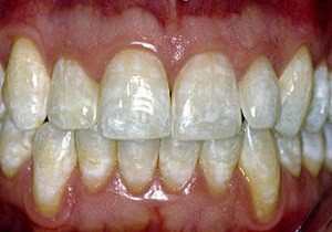 Fluoroza dinților ceea ce este, fotografii și simptome, tratament la copii și adulți