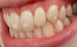 Флюороз зубів що це таке, фото і симптоми, лікування у дітей та дорослих