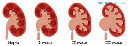 Hydronephrosis a rinichiului stâng în simptomele copilului și de tratament