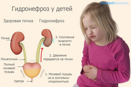 Гідронефроз лівої нирки у дитини симптоми і лікування