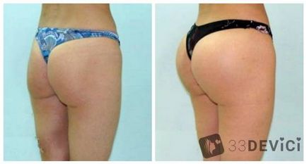 Costul gluteoplastiei, fotografie înainte și după procedură