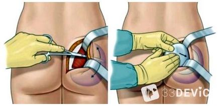 Costul gluteoplastiei, fotografie înainte și după procedură