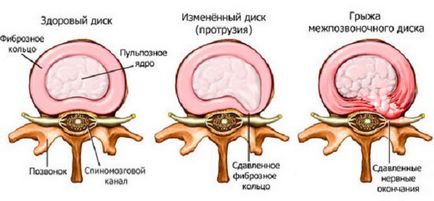 Herniated discuri intervertebrale ale coloanei vertebrale lombare