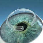 Implantarea inelelor stromale este cel mai eficient tratament pentru keratoconus în ochiul Moscovei