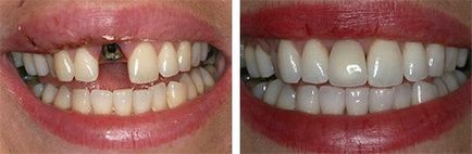 Implantarea dinților în Belgia, implanturi utilizate în străinătate