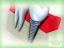 Implantarea dinților în zona Mitino