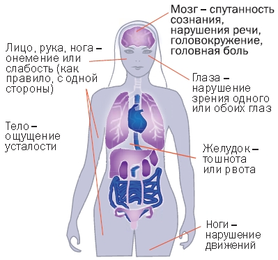 Інсульт відобразимо удар!