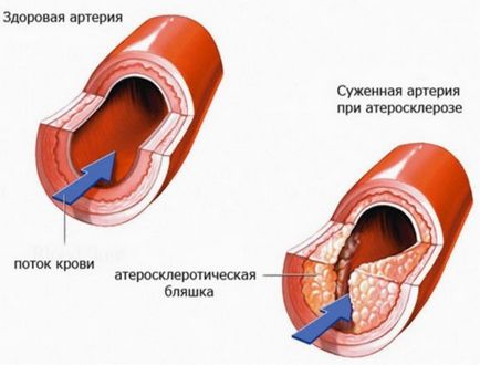 Boala cardiacă ischemică (ibs) și yoga, yoga, slavyoga