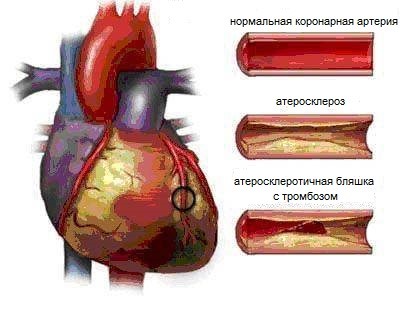 Boala cardiacă ischemică (ibs) și yoga, yoga, slavyoga