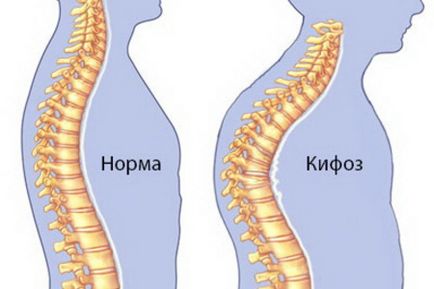 Curbură a coloanei vertebrale în copil provoacă