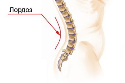 Curbură a coloanei vertebrale în copil provoacă