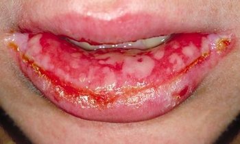 Igaz pemphigus (acantholyticus) vagy pemphigus tünetek, okok, kezelés, prognózis