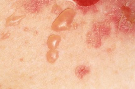 Igaz pemphigus (acantholyticus) vagy pemphigus tünetek, okok, kezelés, prognózis