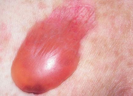 Igaz pemphigus (acantholyticus) vagy pemphigus tünetek, okok, kezelés, prognózis