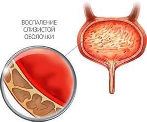 Cât de repede să vindeci cistita la bărbații acasă cu remedii folclorice, ce comprimate și