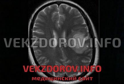 Які демієлінізуючі захворювання відомі, крім розсіяного склерозу