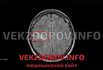 Які демієлінізуючі захворювання відомі, крім розсіяного склерозу